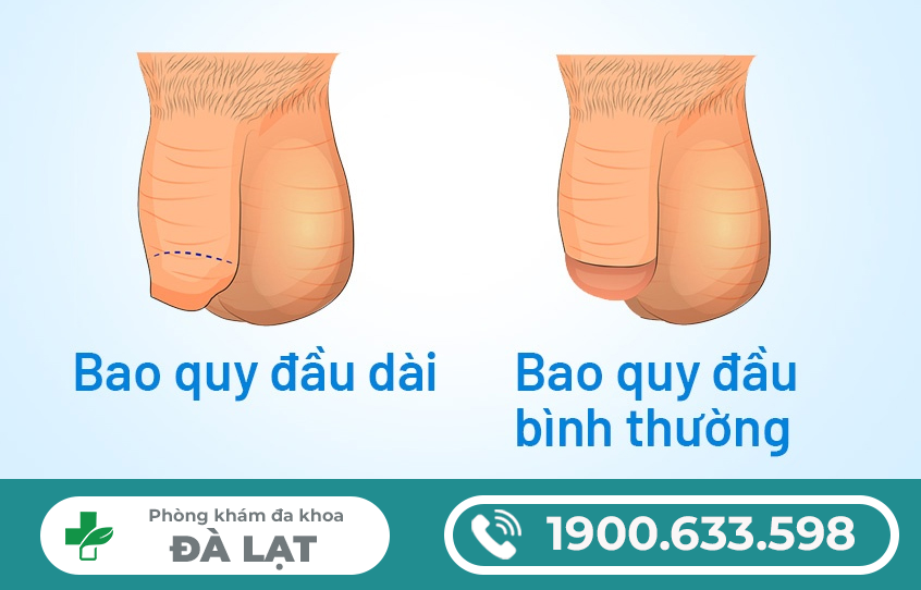 NGUYÊN NHÂN DÀI BAO QUY ĐẦU